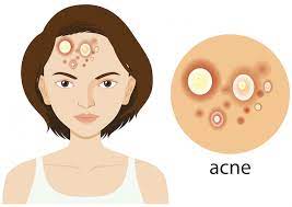 What type of acne do you have?