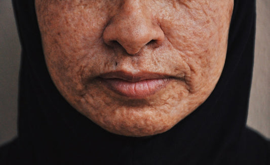 adult-acne