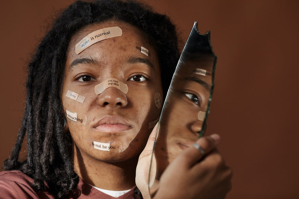 i am NOT my acne/skin
