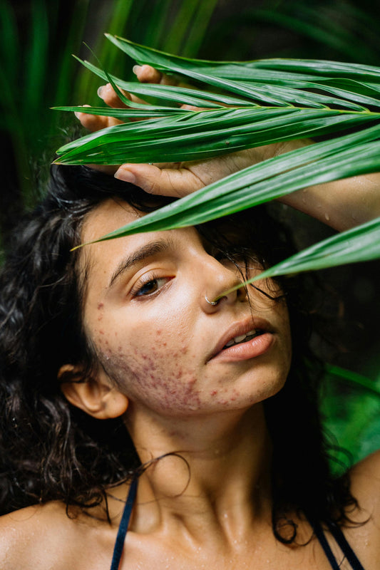 Do you have severe acne