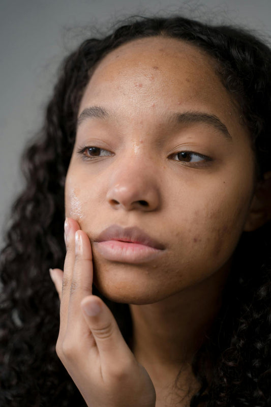 9 Steps to Managing Acne